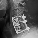 Fig. 3 Lateral radiograph of the cervical spine made after completion of the staged procedures.
