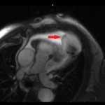 Fig. 1 Sagittal cut from T1-weighted contrast MRI demonstrating invasion of the apex of the heart (arrow) and into the left ventricle with infiltration into the myocardium of the wall of the left ventricle. A = anterior, and R = right.
