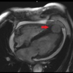 Fig. 2 Sagittal cut from T1-weighted contrast MRI demonstrating the full expanse of the mass (arrow) as it protrudes beyond the anterior wall of the heart. A = anterior, and R = right.
