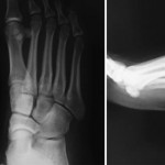 Fig. 1 Anteroposterior, oblique, and lateral radiographs of the right foot.
