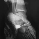Fig. 4 An oblique radiograph of the right foot during the injection of lidocaine showing contrast medium between the cuboid and the navicular.

