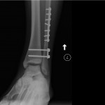 Fig. 1-A Postoperative weight-bearing radiograph, mortise view. Fixation of the fibular fracture with a lateral plate and screws and a separate two-hole plate and screws placed distally for fixation of the syndesmosis. Widening of the tibiotalar clear space is evident.
