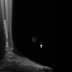 Fig. 1-B Postoperative weight-bearing radiograph, lateral view. The talar dome is centered under the concavity of the distal tibial plafond. Widening of the tibiotalar clear space is evident.
