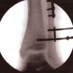 Fig. 3-B Intraoperative fluoroscopic image. The proximal screw has been backed out of the tibia. The distal screw remains engaged in the lateral tibial cortex. The tibiotalar clear space remains widened.
