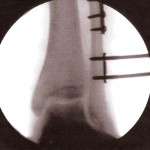 Fig. 3-C Intraoperative fluoroscopic image. Both screws have been backed out of the tibia but remain engaged in the fibula. A slight decrease in the tibiotalar clear space is noted.
