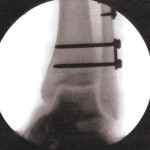 Fig. 3-D Intraoperative fluoroscopic image. After a gentle impact on the plantar aspect of the foot, the screws are again advanced into the tibia. The talus has returned to its anatomic position, and the tibiotalar clear space has returned to normal. Note also the widening of the distal tibiofibular clear space compared with that seen on Figure 3-A.
