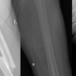 Fig. 1 Radiographs showing the left femoral fracture preoperatively (Fig. 1-A), at two months postoperatively (Fig. 1-B), and at five months postoperatively with complete healing (Fig. 1-C).
