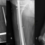 Fig. 2 Radiographs showing the right femoral fracture preoperatively (Fig. 2-A), at two months postoperatively (Fig. 2-B), and at seven months postoperatively with complete consolidation (Fig. 2-C).
