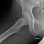 Fig. 1 This frog-leg lateral radiograph of the hip, made six weeks after the onset of symptoms.
