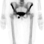 Fig. 4 A bone scan revealed focally increased uptake at the site of the stress fracture of the right inferior pubic ramus.
