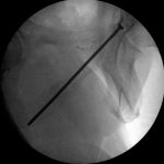 Fig. 5-A Intraoperative obturator outlet fluoroscopic image demonstrating screw placement.
