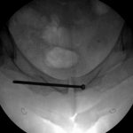 Fig. 5-B Intraoperative obturator inlet fluoroscopic image demonstrating screw placement.
