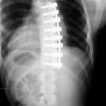 Fig. 1 Postoperative anteroposterior radiograph, made in August 2002, showing anterior spinal instrumentation from T5 to T12.
