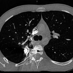 Fig. 2 Representative CT scan of the chest, made with contrast medium at the time of presentation to our institution in April 2012, demonstrating damage to lung parenchyma adjacent to the anterior spine instrumentation.
