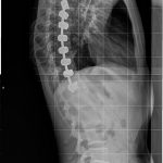 Fig. 4 Lateral radiograph made in May 2012 (ten years after anterior arthrodesis for the treatment of scoliosis), showing the position of the instrumentation relative to the medial aspect of the right lung.
