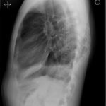 Fig. 6-B Lateral radiograph of the chest, made in December 2012, after removal of all implants and treatment of infection.
