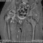 Fig. 2-A MRI: coronal T2-weighted image.
