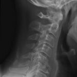 Fig. 1 Lateral radiograph of the cervical spine at presentation.
