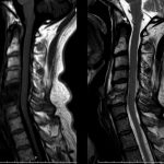 Fig. 2 MRI of the cervical spine. The T1-weighted sagittal image on the left demonstrates decreased T1 signal in the C5 and C6 vertebral bodies. The T2-weighted image on the right demonstrates edema in the C5 and C6 vertebral bodies, loss of C5-C6 disc height, and prevertebral swelling from C3 to C7.
