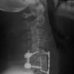 Fig. 3 Postoperative lateral radiograph of the cervical spine. The patient underwent a C5-C6 discectomy, a C6 corpectomy with a Harms cage replacement, instrumented anterior spinal fusion from C5 to C7, and instrumented posterior spinal fusion from C5 to C7.
