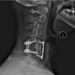 Fig. 4 Lateral radiograph of the cervical spine at twelve months postoperatively demonstrating satisfactory alignment of the instrumentation with no changes.
