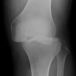 Fig. 1-A Anteroposterior radiograph showing the posterolateral dislocation of the knee.

