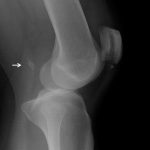 Fig. 1-B Lateral radiograph showing the posterolateral dislocation of the knee and an avulsed bone fragment (arrow) in the posterior aspect of the femoral condyle.
