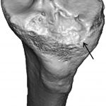 Fig. 2-B Three-dimensional CT of the injured knee revealing a depression of the anterolateral corner of the tibial plateau (arrow).
