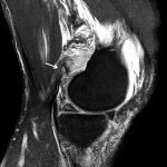 Fig. 3-A MRI (proton-density image) of the injured knee. The sagittal view shows the bone fragment (arrow).
