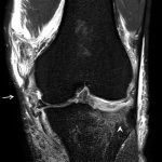 Fig. 3-B MRI (proton-density images) of the injured knee. The coronal view shows signal changes of soft tissue in the posteromedial part of the knee, including the MCL (arrow). Intense signal changes were found in the anterolateral corner of the tibial plateau (arrowhead).
