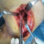 Fig. 5 Macroscopic view of the knee during surgery. A bone fragment was avulsed from the posterior part of the medial femoral condyle and attached to the medial head of the gastrocnemius muscle (arrow).
