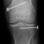 Fig. 6-A Anteroposterior radiograph of the knee after surgery shows that the avulsion fracture of the medial head of the gastrocnemius was reduced and fixed with a screw, which resulted in maintenance of joint reduction. The depressed anterolateral corner of the tibial plateau also was reduced and fixed with a screw.
