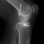 Fig. 6-B Lateral radiograph of the knee after surgery.
