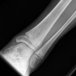 Fig. 1 Radiograph indicating a lesion in the distal aspect of the left fibula.
