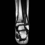 Fig. 2 T1-weighted MRI of the left distal fibular and tibial metaphyses.
