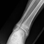 Fig. 3 Radiograph indicating a lesion in the distal aspect of the right fibula.
