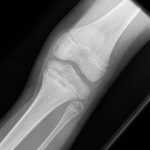 Fig. 4 Radiograph indicating a lesion in the proximal aspect of the left tibia.
