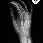 Fig. 5 Radiograph indicating osteolytic lesions in the distal aspects of the left radius and ulna.
