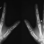 Fig. 1 Radiographs revealing a periarticular calcification at the base of the proximal phalanx of both middle fingers (arrowheads) and osteochondromas on the middle phalanx of the left middle finger and the metacarpus of the left small finger (arrows) at the age of eight years.
