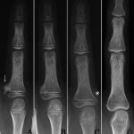 Fig. 3 Radiographs of the right middle finger. Fig. 3-A The untreated osteochondroma of the proximal phalanx (arrow) at the age of ten years and seven months. Fig. 3-B The lesion had gradually decreased in size at the age of eleven years and six months. Fig. 3-C The lesion was mostly resolved at the age of twelve years and nine months. However, a new osteochondroma had arisen on the ulnar side of the proximal phalanx (asterisk). Fig. 3-D The original lesion had completely resolved and the proximal phalanx was restored in the terms of shape at the age of seventeen years and one month. The new osteochondroma had also resolved.
