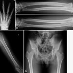 Fig. 4 Radiographs of both hands (Figs. 4-A and 4-B), both forearms (Figs. 4-C and 4-D), both humeri (Figs. 4-E and 4-F), the pelvis and proximal aspects of both femora (Fig. 4-G), the proximal aspects of both tibiae and fibulae (Figs. 4-H and 4-I), and the distal aspects of both tibiae and fibulae (Figs. 4-J and 4-K) revealing no enchondromatous or osteochondromatous lesions.
