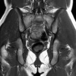 Fig. 5 Coronal T1-weighted STIR (short tau inversion recovery) MRI scan of the pelvis showed no recognizable enchondromas.
