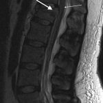 Fig. 2-B T2-weighted sagittal MRI of the thoracolumbar spine at the L1 level with fragment (thick arrow) and associated edema (thin arrow).
