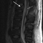 Fig. 3 T2-weighted sagittal MRI of the reduced L1 burst fracture (thick arrow) and decompression of the conus medullaris, which is swollen (thin arrow) as shown by the bright T2 signal.
