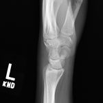 Fig. 2 Lateral radiograph of the left wrist demonstrating lucency in the middle and distal aspects of the scaphoid.
