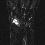 Fig. 4 Coronal STIR (short tau inversion recovery)-weighted MRI showing an expansile, enhancing lesion.
