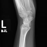 Fig. 9 Lateral radiograph at the latest follow-up (23 months following surgery) showing that signs of the prior lesion and recurrence are absent.
