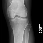 Fig. 1-A Anteroposterior radiograph of the left knee.
