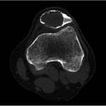 Fig. 2 Axial CT of the left knee showing the patellar lesion.

