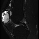 Fig. 3 Sagittal T2-weighted MRI of the left knee.
